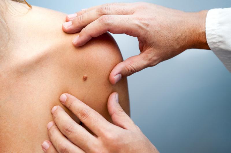 melanoma